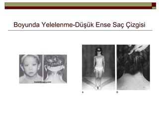 Boyunda Yelelenme-Düşük Ense Saç Çizgisi
 