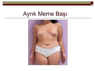 Ayrık Meme Başı
 