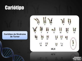 Cariótipo
Cariótipo da Síndrome
de Turner
 