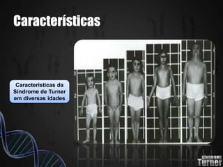 Características
Características da
Síndrome de Turner
em diversas idades
 