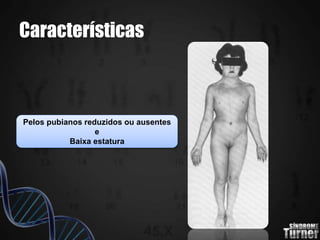 Características
Pelos pubianos reduzidos ou ausentes
e
Baixa estatura
 