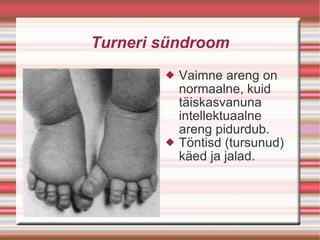 Turneri sündroom Vaimne areng on normaalne, kuid täiskasvanuna  intellektuaalne areng pidurdub. Töntisd (tursunud) käed ja jalad. 