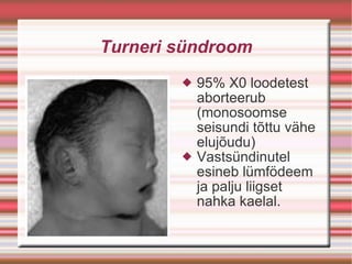 Turneri sündroom 95% X0 loodetest aborteerub (monosoomse seisundi tõttu vähe elujõudu)‏ Vastsündinutel esineb lümfödeem ja palju liigset  nahka kaelal. 
