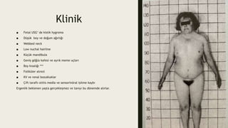 Klinik
■ Fetal USG’ de kistik hygroma
■ Düşük boy ve doğum ağırlığı
■ Webbed neck
■ Low nuchal hairline
■ Küçük mandibula
■ Geniş göğüs kafesi ve ayrık meme uçları
■ Boy kısalığı ***
■ Foliküler atrezi
■ KV ve renal bozukluklar
■ Çift taraflı otitis media ve sensorinöral işitme kaybı
Ergenlik beklenen yaşta gerçekleşmez ve tanıyı bu dönemde alırlar.
 