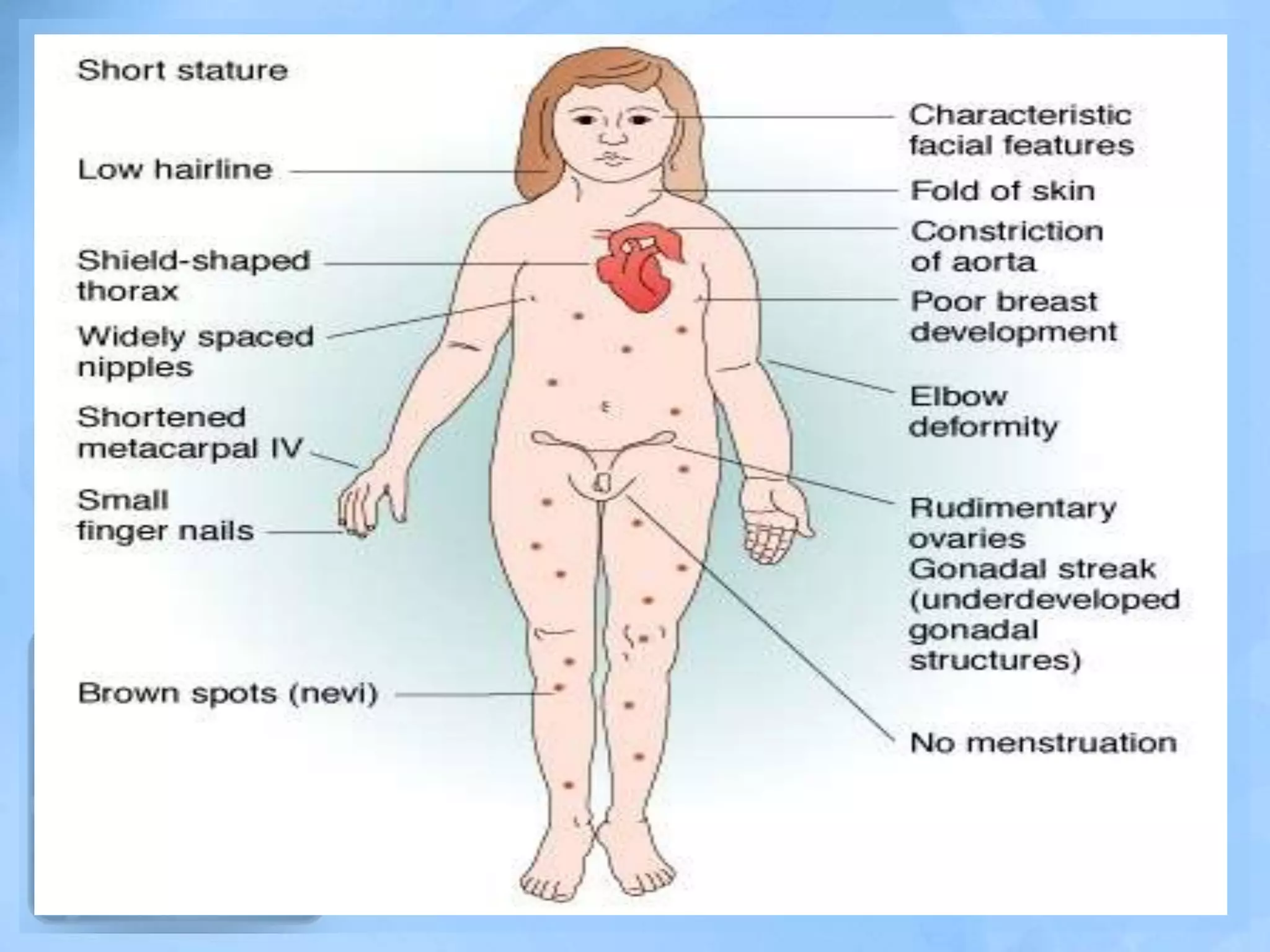 Turner s Syndrome PPTX turner-s-syndrome-pptx