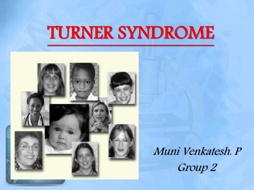 Turner's syndrome