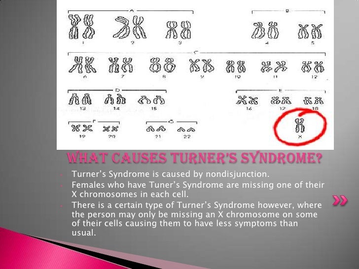 Turner’s Syndrome Project