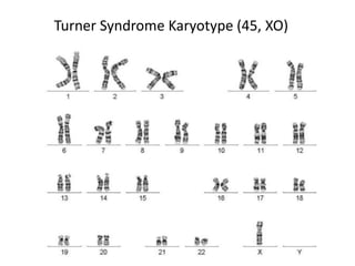 Turner syndrome | PPTX