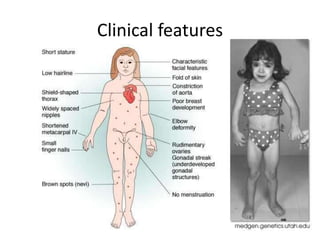 Clincial Features Psychological Characteristics Of Turner Syndrome. – VNMNM