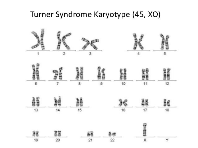 a chromosomal disorder resulting in a syndrome characterized by turners syndrome Turner syndrome is thought to occur in 1 in every 2000 girls born in was first described in 1938 by dr henry turner 23 chromosomes, the result would be. a chromosomal disorder resulting in a syndrome characterized by turners syndrome Turner syndrome is thought to occur in 1 in every 2000 girls born in was first described in 1938 by dr henry turner 23 chromosomes, the result would be.