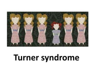 Turner syndrome
 