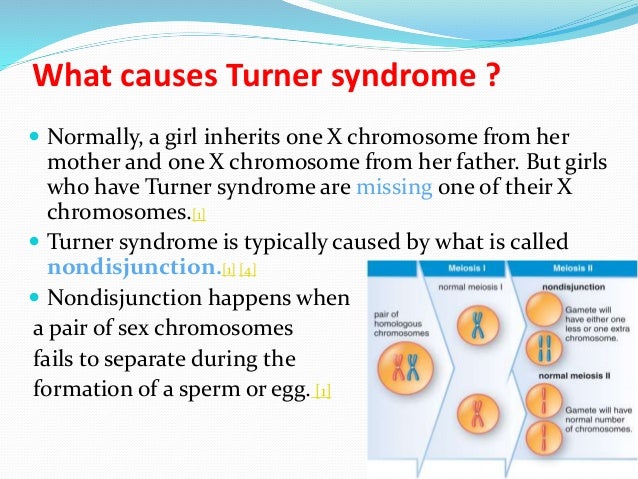 Turner Syndrome Meiotic Nondisjunction Captions More