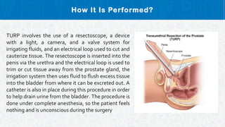 How It Is Performed?
TURP involves the use of a resectoscope, a device
with a light, a camera, and a valve system for
irrigating fluids, and an electrical loop used to cut and
cauterize tissue. The resectoscope is inserted into the
penis via the urethra and the electrical loop is used to
trim or cut tissue away from the prostate gland, the
irrigation system then uses fluid to flush excess tissue
into the bladder from where it can be excreted out. A
catheter is also in place during this procedure in order
to help drain urine from the bladder. The procedure is
done under complete anesthesia, so the patient feels
nothing and is unconscious during the surgery
 
