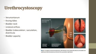 Urethrocystoscopy
• Verumontanum
• Kissing lobes
• Bladder neck
• Ureteral orifices
• Bladder trabeculation ; sacculation,
diverticula
• Bladder capacity
 