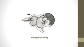 RetrogradeCutting
 