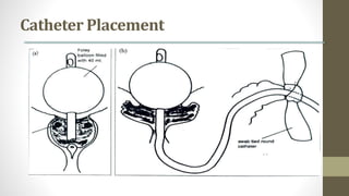 Catheter Placement
 