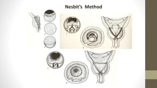 Nesbit’s Method
 