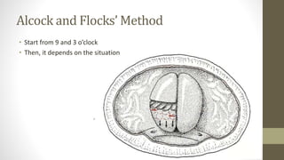 Alcock and Flocks’ Method
• Start from 9 and 3 o’clock
• Then, it depends on the situation
 