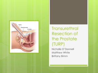 Transurethral
Resection of
the Prostate
(TURP)
Nicholle O’Donnell
Matthew White
Brittany Bimm
 