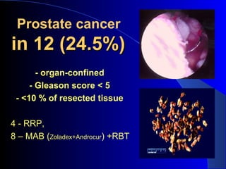 Prostate cancer
in 12 (24.5%)in 12 (24.5%)
- organ-confined
- Gleason score < 5
- <10 % of resected tissue
4 - RRP,
8 – MAB (Zoladex+Androcur) +RBT
 