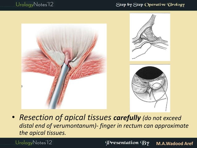 TURP step by step operative urology | PDF | First Aid | Injuries