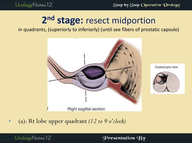Turp Risk Stratification TURP step by step operative urology | PDF | First Aid | Injuries
