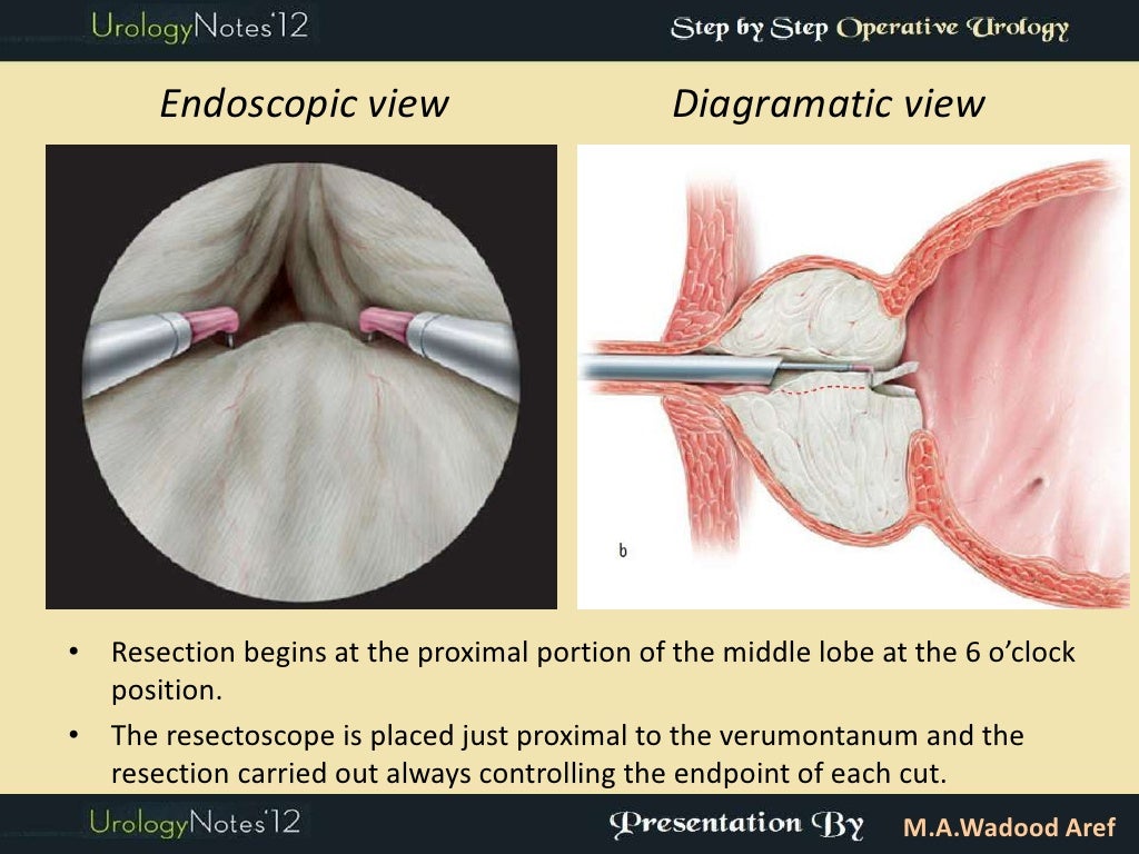 TURP step by step operative urology