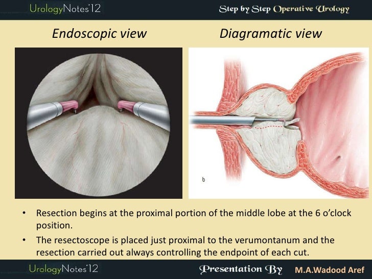 TURP step by step operative urology