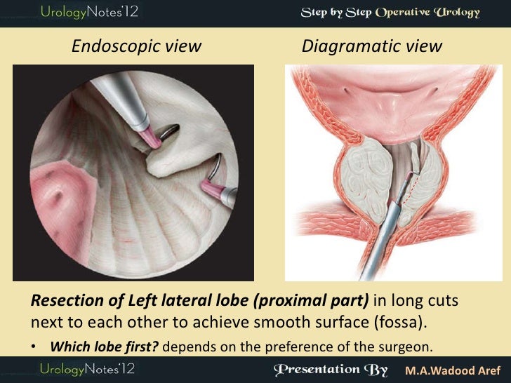 TURP step by step operative urology
