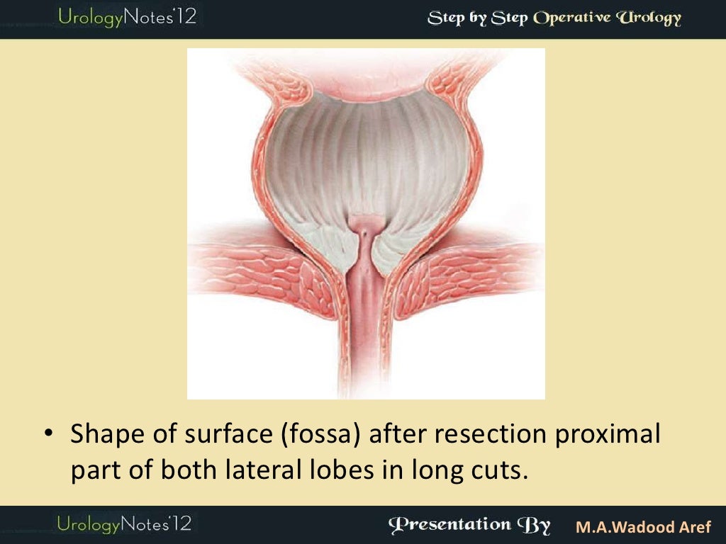 TURP step by step operative urology