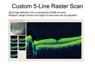 Octmac 5 Line Raster Optical Coherence Tomography | PPTX