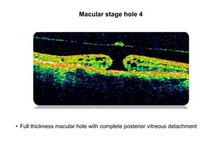 Macular Complete Optical Coherence Tomography | PPTX