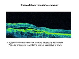 Optical Coherence Tomography | PPTX