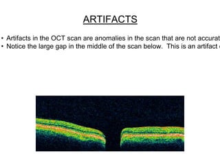 Oct Artefact Example Optical Coherence Tomography | PPTX