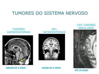 TUMORES DO SISTEMA NERVOSOABAIXO DE 2 ANOSACIMA DE 2 ANOSATÉ 10 ANOS 
TUMORES SUPRATENTORIAIS 
60% 
INFRATENTORIAIS 
3-6% TUMORES 
MEDULARES  