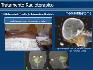 Tratamento Radioterápico 
IMRT-Terapia de Irradiação Intensidade Modulada Meduloblastoma 
radioterapia ao crânio e neuro-eixo 
Agradecimento: Prof. Dr. Eduardo Weltman 
Dr. Fernando Ladeia 
 