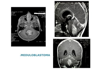 ●MEDULOBLASTOMA  