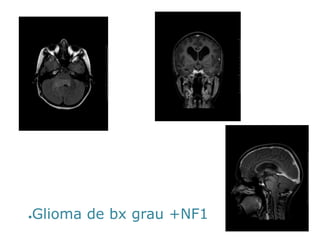 ●Gliomade bxgrau +NF1  