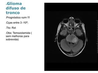 ●Gliomadifuso de tronco 
•Prognóstico ruim !!! 
•Cçasentre 3 -10ª; 
•Tto: Rxt 
•Obs: Temozolamida( sem melhoras para sobrevida)  