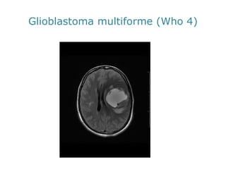 Glioblastomamultiforme (Who 4)  