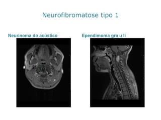 Neurofibromatosetipo 1 
Neurinomado acústico 
Ependimomagrau Ii  