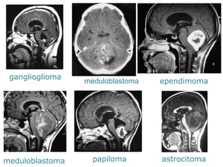 ganglioglioma 
meduloblastoma 
ependimoma 
meduloblastoma 
papiloma 
astrocitoma  