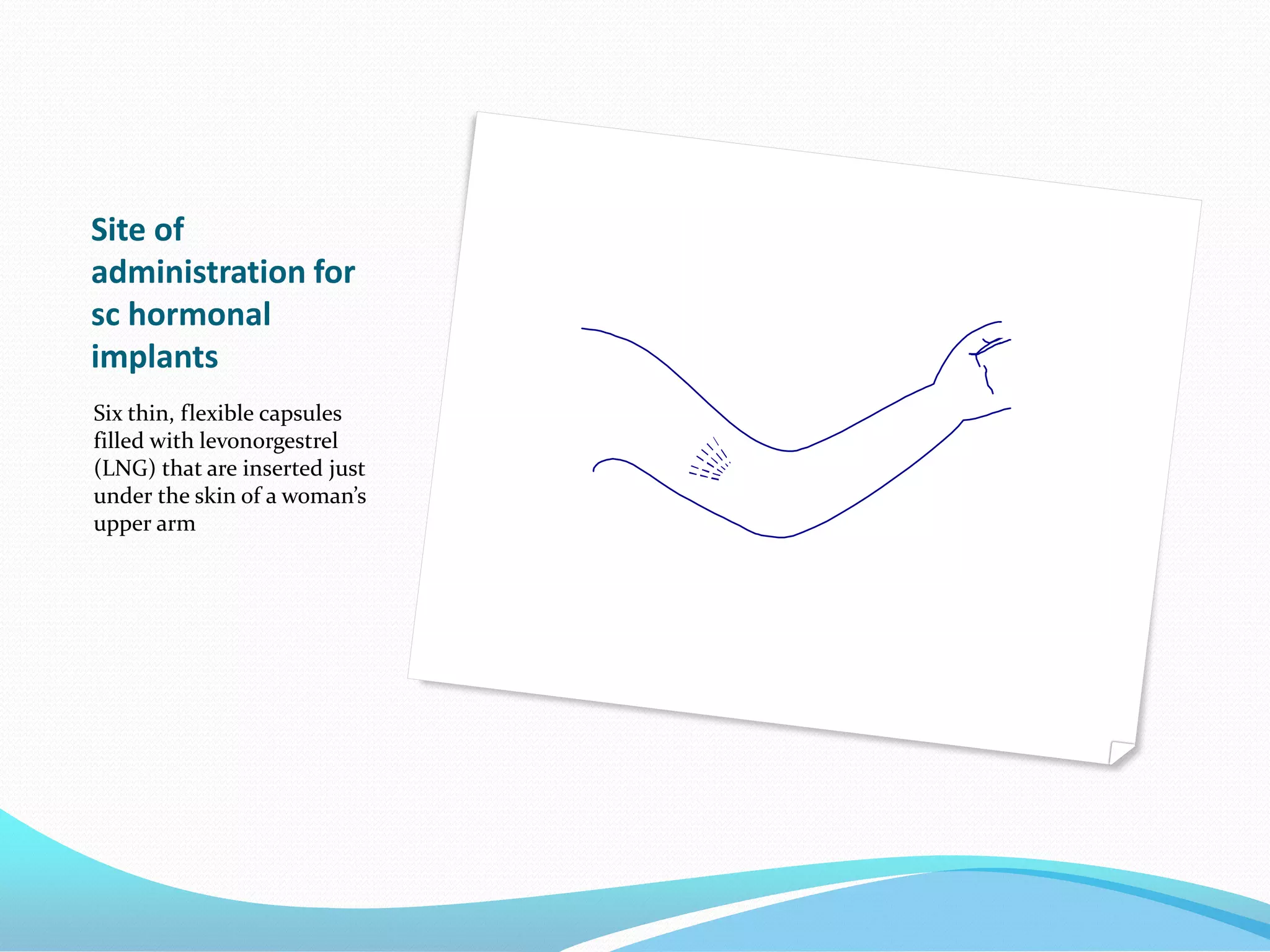 Site of
administration for
sc hormonal
implants
Six thin, flexible capsules
filled with levonorgestrel
(LNG) that are inserted just
under the skin of a woman’s
upper arm
 