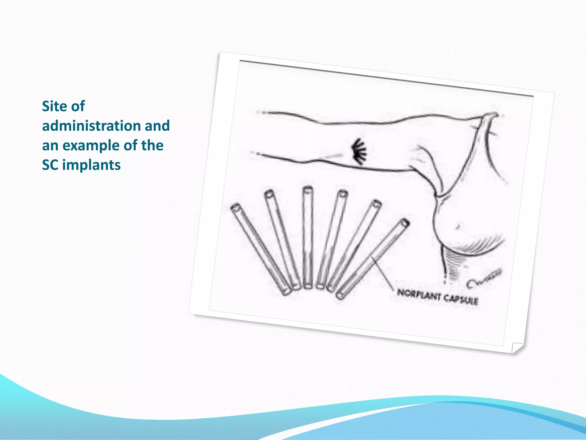 Site of
administration and
an example of the
SC implants
 