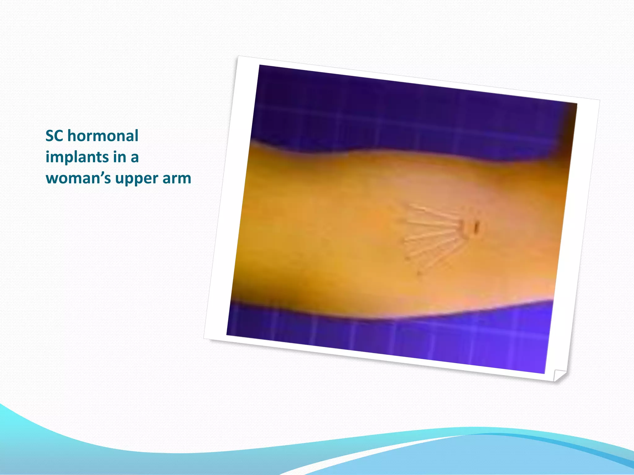 SC hormonal
implants in a
woman’s upper arm
 