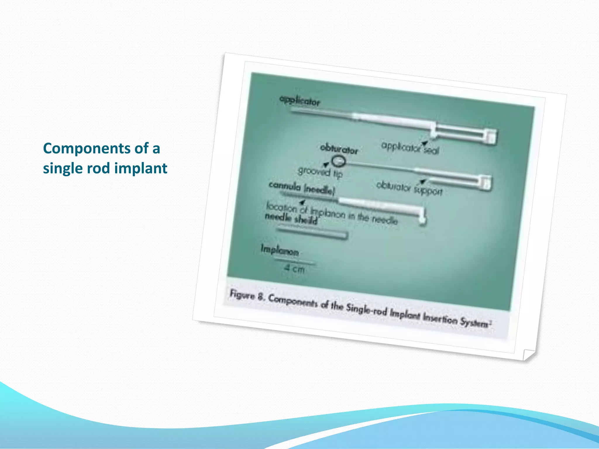Components of a
single rod implant
 