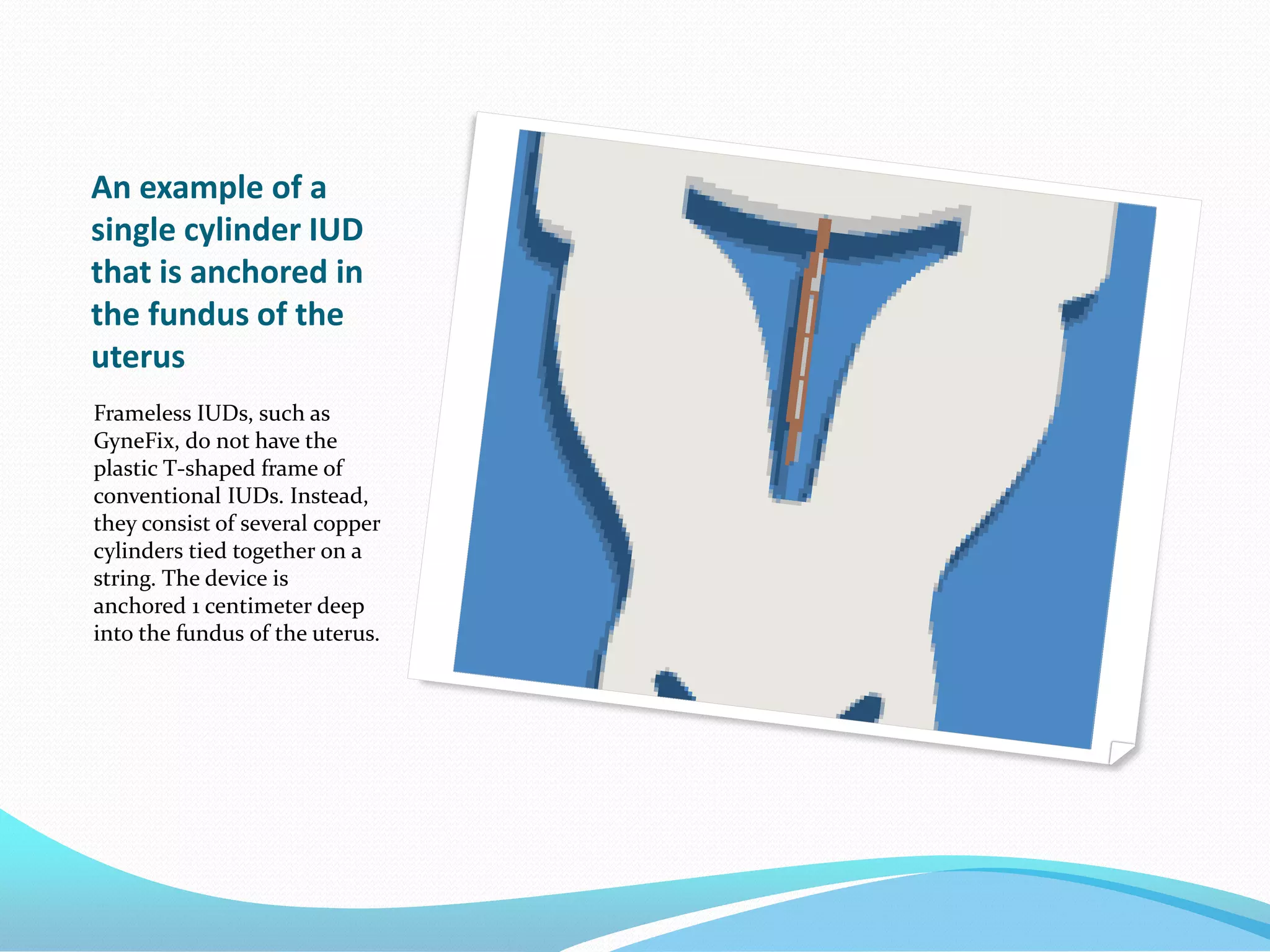 An example of a
single cylinder IUD
that is anchored in
the fundus of the
uterus
Frameless IUDs, such as
GyneFix, do not have the
plastic T-shaped frame of
conventional IUDs. Instead,
they consist of several copper
cylinders tied together on a
string. The device is
anchored 1 centimeter deep
into the fundus of the uterus.
 