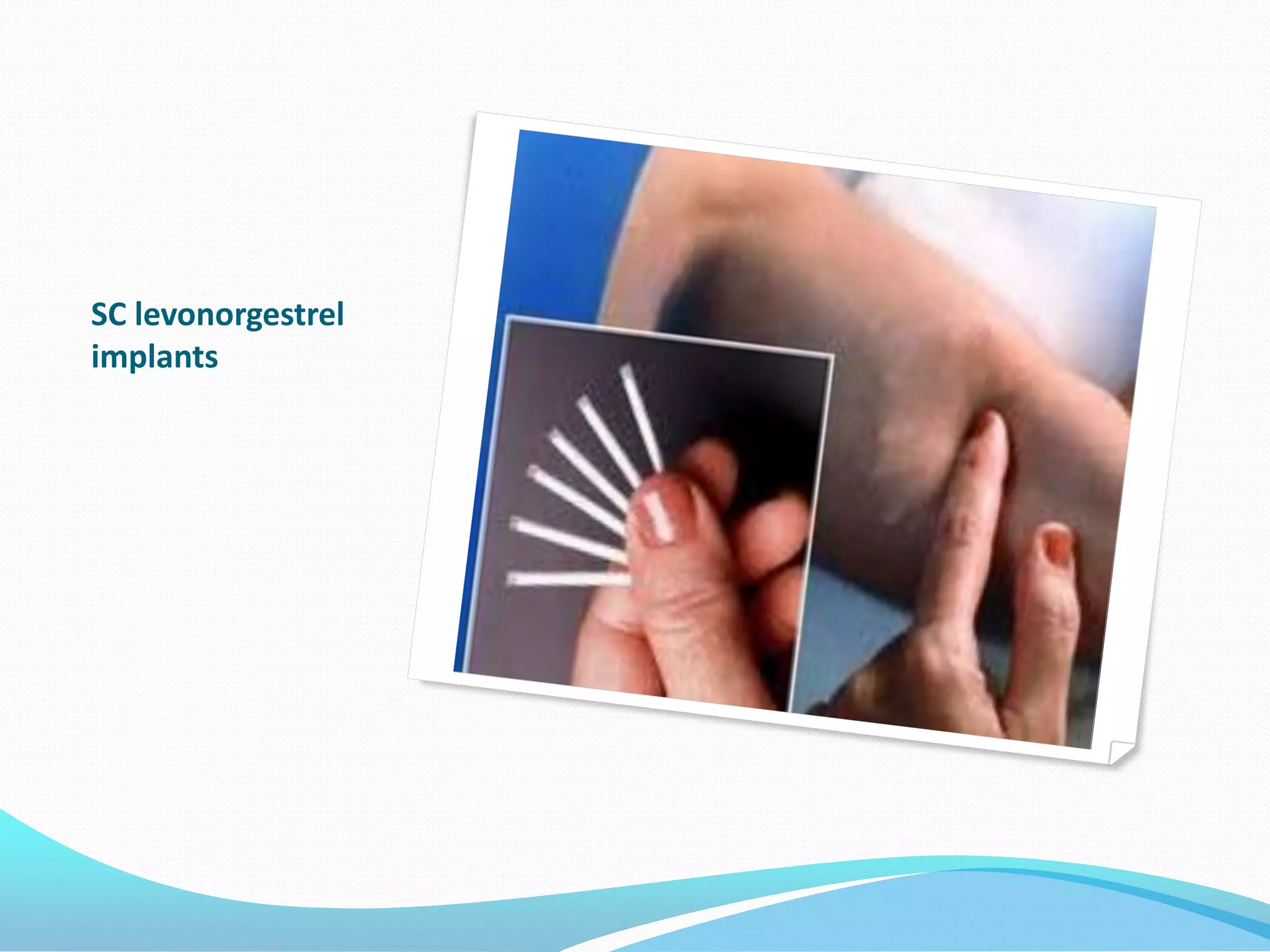 SC levonorgestrel
implants
 