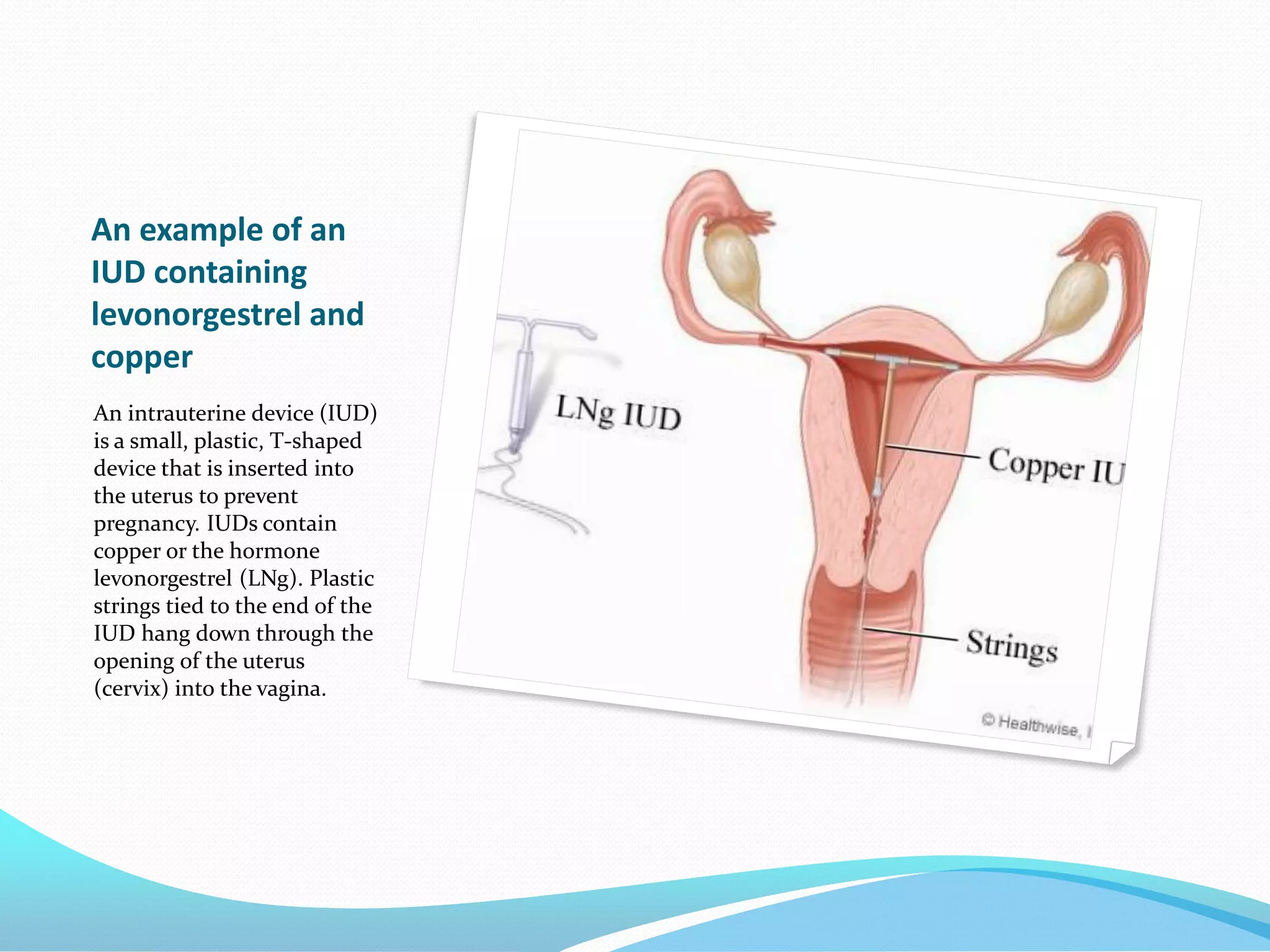 An example of an
IUD containing
levonorgestrel and
copper
An intrauterine device (IUD)
is a small, plastic, T-shaped
device that is inserted into
the uterus to prevent
pregnancy. IUDs contain
copper or the hormone
levonorgestrel (LNg). Plastic
strings tied to the end of the
IUD hang down through the
opening of the uterus
(cervix) into the vagina.
 