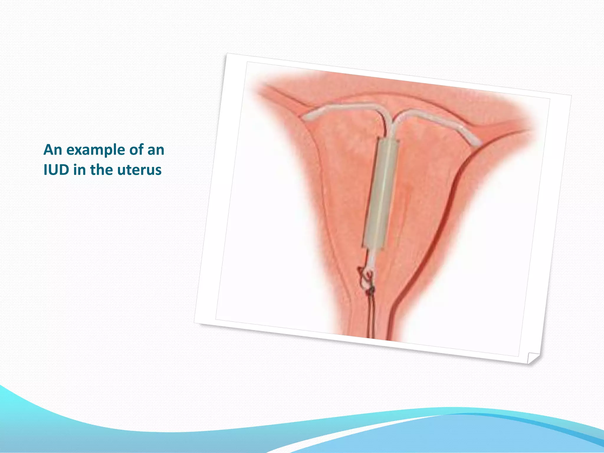 An example of an
IUD in the uterus
 